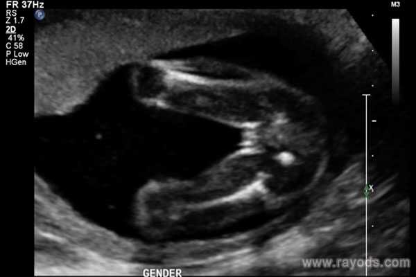 供卵代生孩子该注意什么,六安助孕提醒：教你美国试管婴儿怎么避免胚胎发育